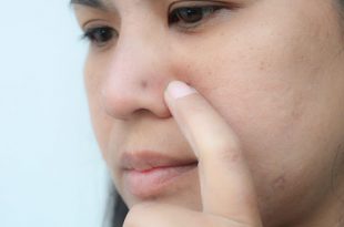 cicatrizzare piercing naso